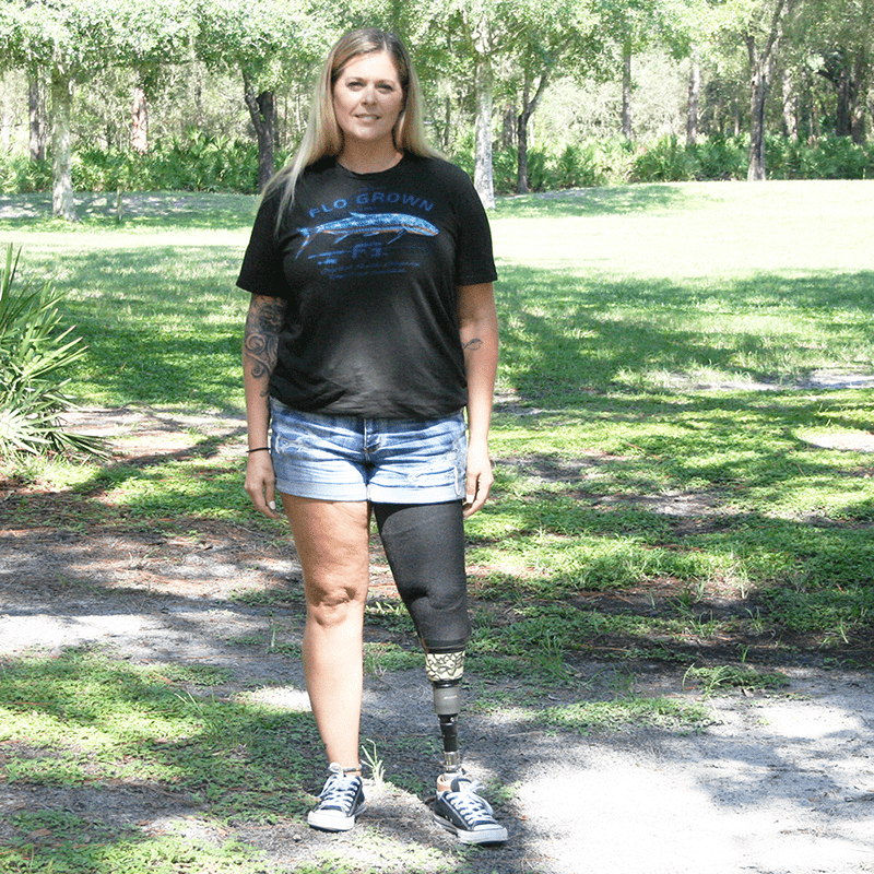 Woman with prosthetic leg is happy, despite her condition Stock