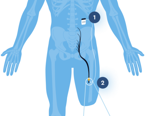Phantom Limb Pain After Amputation: Treatment Options